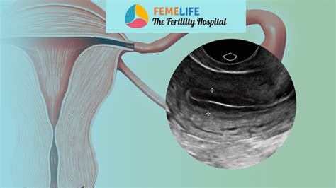 thick uterine lining positive pregnancy test|pregnancy line thickness.